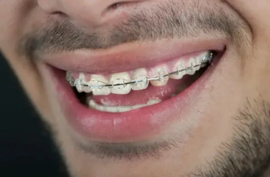 Брекеты на службе: как зубные аппараты влияют на призыв в армию