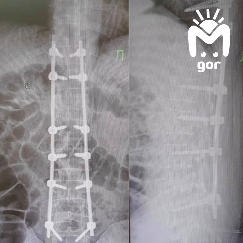 Ингушские врачи вернули пациенту возможность ходить после тяжёлой травмы позвоночника