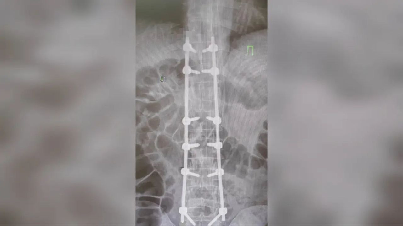 Нейрохирурги РКБ Ингушетии вернули пациенту возможность ходить